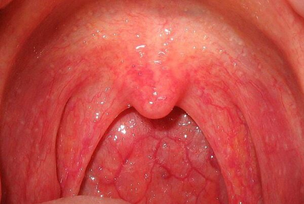 Remedies for sore throat